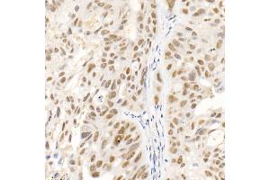 Immunohistochemistry of paraffin-embedded human colon carcinoma using SOCS1 Rabbit mAb (ABIN7270640) at dilution of 1:100 (40x lens).