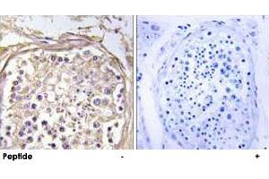 Immunohistochemistry analysis of paraffin-embedded human breast carcinoma tissue using CHST9 polyclonal antibody . (CHST9 antibody)