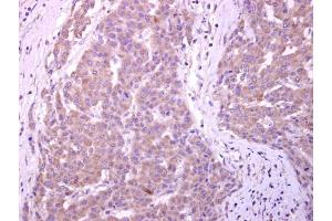 IHC-P Image CYP7B1 antibody [C3], C-term detects CYP7B1 protein at cytoplasm on human liver carcinoma by immunohistochemical analysis. (CYP7B1 antibody  (C-Term))