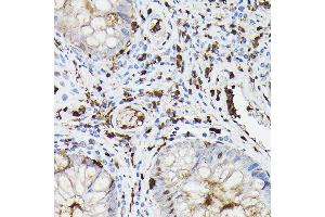 Immunohistochemistry of paraffin-embedded human colon carcinoma using Gelsolin Rabbit pAb (ABIN7267365) at dilution of 1:50 (40x lens). (Gelsolin antibody  (AA 543-782))