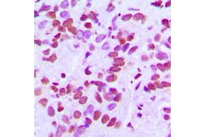 Immunohistochemical analysis of CANP staining in human breast cancer formalin fixed paraffin embedded tissue section. (Calpain S1 antibody  (Center))