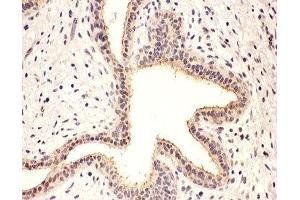 IHC-P: Rab8 antibody testing of human breast cancer tissue (RAB8A antibody  (C-Term))