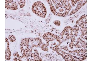 IHC-P Image Immunohistochemical analysis of paraffin-embedded human breast cancer, using ZNF148 antibody [N1N2], N-term, antibody at 1:250 dilution. (ZNF148 antibody  (N-Term))