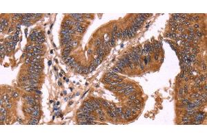 Immunohistochemistry of paraffin-embedded Human colon cancer using ERP29 Polyclonal Antibody at dilution of 1:40 (ERP29 antibody)