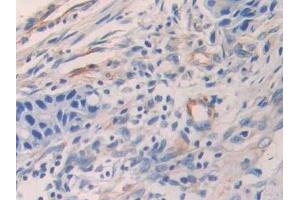 Detection of ENA78 in Human Colorectal cancer Tissue using Polyclonal Antibody to Epithelial Neutrophil Activating Peptide 78 (ENA78) (CXCL5 antibody  (AA 38-114))