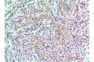 Immunohistochemistry (IHC) analysis of paraffin-embedded Human Breast Cancer, antibody was diluted at 1:200. (p300 antibody)