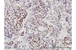 Immunoperoxidase of monoclonal antibody to RNU3IP2 on formalin-fixed paraffin-embedded human ovary, clear cell carcinoma. (RRP9 antibody  (AA 1-475))