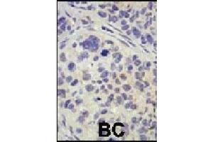 Formalin-fixed and paraffin-embedded human cancer tissue reacted with the primary antibody, which was peroxidase-conjugated to the secondary antibody, followed by AEC staining. (USP8 antibody  (C-Term))