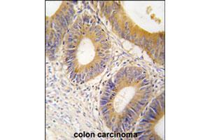 Formalin-fixed and paraffin-embedded human colon carcinoma tissue reacted with ALDOC polyclonal antibody  , which was peroxidase-conjugated to the secondary antibody, followed by DAB staining.