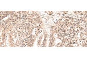 Immunohistochemistry of paraffin-embedded Human liver cancer tissue using EXOSC9 Polyclonal Antibody at dilution of 1:35(x200)