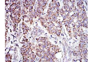 Immunohistochemical analysis of paraffin-embedded liver cancer tissues using PHB mouse mAb with DAB staining. (Prohibitin antibody)