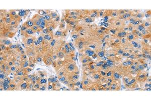 Immunohistochemistry of paraffin-embedded Human liver cancer tissue using DKK2 Polyclonal Antibody at dilution 1:60 (DKK2 antibody)