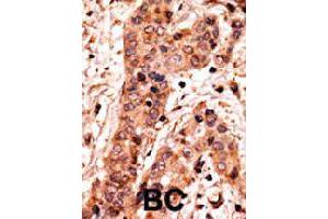 Formalin-fixed and paraffin-embedded human breast cancer tissue reacted with GUCY1A2 polyclonal antibody  , which was peroxidase-conjugated to the secondary antibody, followed by AEC staining. (GUCY1A2 antibody  (C-Term))