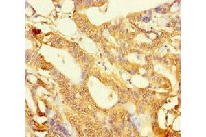 Immunohistochemistry of paraffin-embedded human colon cancer using ABIN7158821 at dilution of 1:100 (LYG2 antibody  (AA 20-212))