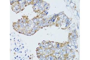 Immunohistochemistry of paraffin-embedded Human rectal cancer using EGFR Polyclonal Antibody at dilution of 1:100 (40x lens). (EGFR antibody)