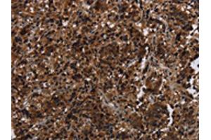The image on the left is immunohistochemistry of paraffin-embedded Human liver cancer tissue using ABIN7191356(MAGEE1 Antibody) at dilution 1/30, on the right is treated with synthetic peptide. (MAGEE1 antibody)