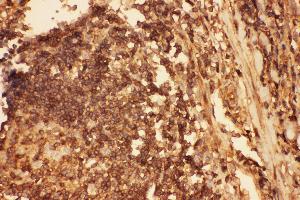 Anti-Cofilin Picoband antibody,  IHC(P): Human Intestinal Cancer Tissue