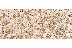 Immunohistochemistry of paraffin-embedded Human liver cancer tissue using PDXK Polyclonal Antibody at dilution of 1:75(x200) (PDXK antibody)