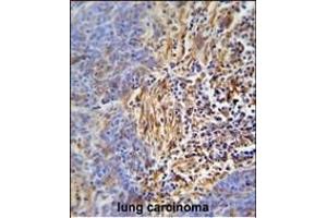 HLA-DRB5 Antibody (Center) (ABIN653782 and ABIN2843069) immunohistochemistry analysis in formalin fixed and paraffin embedded human lung carcinoma followed by peroxidase conjugation of the secondary antibody and DAB staining. (HLA-DRB5 antibody  (AA 43-70))