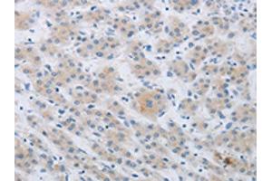 The image on the left is immunohistochemistry of paraffin-embedded Human liver cancer tissue using ABIN7190267(CKMT1A/CKMT1B Antibody) at dilution 1/80, on the right is treated with synthetic peptide. (CKMT1A antibody)