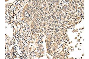 The image on the left is immunohistochemistry of paraffin-embedded Human lung cancer tissue using ABIN7131591(VPS53 Antibody) at dilution 1/20, on the right is treated with fusion protein. (VPS53 antibody)