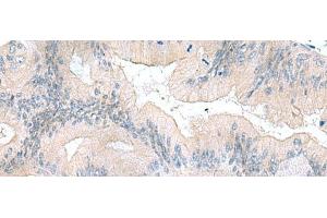 Immunohistochemistry of paraffin-embedded Human colorectal cancer tissue using UBE2F Polyclonal Antibody at dilution of 1:70(x200) (UBE2F antibody)