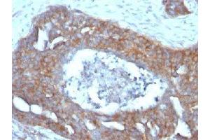 IHC testing of FFPE human ovarian carcinoma with Estrogen Inducible Protein pS2 antibody (TFF1 antibody  (C-Term))
