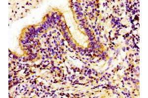 Immunohistochemistry of paraffin-embedded human lung cancer using ABIN7157016 at dilution of 1:100 (Involucrin antibody  (AA 24-118))