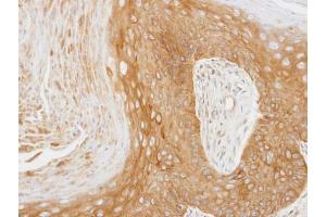 IHC-P Image Immunohistochemical analysis of paraffin-embedded Cal27 xenograft, using 14-3-3 zeta, antibody at 1:100 dilution. (14-3-3 zeta antibody  (Center))
