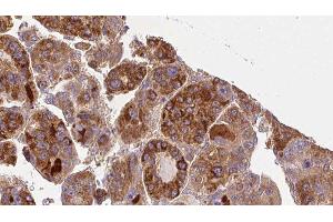 ABIN6277326 at 1/100 staining Human liver cancer tissue by IHC-P. (GNA11 antibody  (Internal Region))