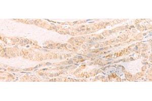 Immunohistochemistry of paraffin-embedded Human thyroid cancer tissue using EREG Polyclonal Antibody at dilution of 1:35(x200) (Epiregulin antibody)