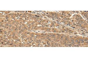 Immunohistochemistry of paraffin-embedded Human liver cancer tissue using CBLN3 Polyclonal Antibody at dilution of 1:25(x200) (CBLN3 antibody)