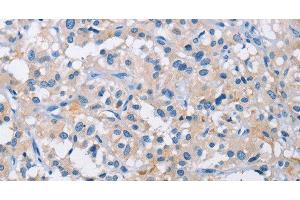 Immunohistochemistry of paraffin-embedded Human thyroid cancer tissue using ATP6AP2 Polyclonal Antibody at dilution 1:50 (ATP6AP2 antibody)