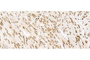 Immunohistochemistry of paraffin-embedded Human liver cancer tissue using NHP2 Polyclonal Antibody at dilution of 1:55(x200) (NHP2 antibody)