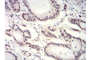 Immunohistochemical analysis of paraffin-embedded colon cancer tissues using HIST2H3C(27Ac) mouse mAb with DAB staining. (Histone Cluster 2, H3c (HIST2H3C) (acLys27) antibody)