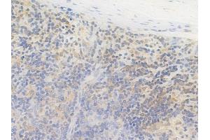 ABIN6264249 and ABIN6269096 at 1/100 staining human melanoma by IHC-P. (Pkc beta 1 antibody  (C-Term))