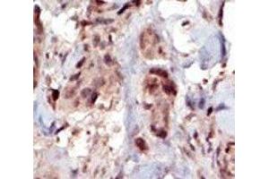 IHC analysis of FFPE human breast carcinoma tissue stained with the SPHK2 antibody (SPHK2 antibody  (AA 590-620))