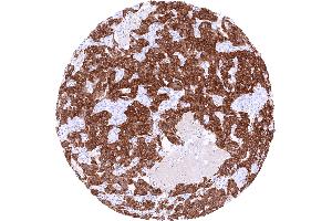 Pancreatic neuroendocrine tumor with strong GAD2 immunostaining of tumor cells (GAD65 antibody  (AA 6-99))