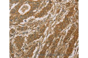 Immunohistochemistry of Human thyroid cancer using CYP39A1 Polyclonal Antibody at dilution of 1:50 (CYP39A1 antibody)