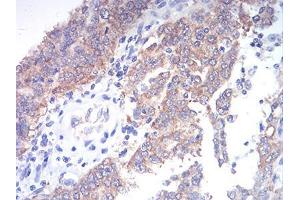 Immunohistochemical analysis of paraffin-embedded endometrial cancer tissues using TBCC mouse mAb with DAB staining. (TBCC antibody  (AA 1-196))