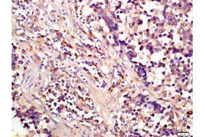 Formalin-fixed and paraffin embedded human lung carcinoma labeled with Anti-phospho-eIF4EBP1(Ser64) Polyclonal Antibody, Unconjugated (ABIN682963) at 1:200 followed by conjugation to the secondary antibody and DAB staining