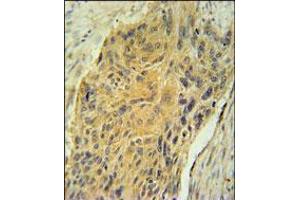 AVP Antibody immunohistochemistry analysis in formalin fixed and paraffin embedded human lung carcinoma followed by peroxidase conjugation of the secondary antibody and DAB staining. (Vasopressin antibody  (AA 102-129))