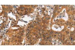 Immunohistochemistry of paraffin-embedded Human gastic cancer using ITGA2 Polyclonal Antibody at dilution of 1:30 (ITGA2 antibody)