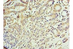 Immunohistochemistry of paraffin-embedded human breast cancer using ABIN7142902 at dilution of 1:100
