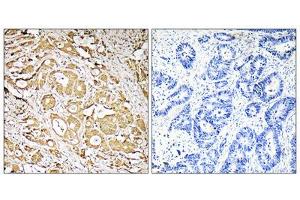 Immunohistochemistry analysis of paraffin-embedded human colon carcinoma tissue, using MRPS7 antibody. (FUT3 antibody  (Internal Region))