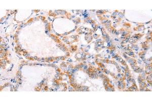 Immunohistochemistry of paraffin-embedded Human thyroid cancer using TRAF5 Polyclonal Antibody at dilution of 1:30 (TRAF5 antibody)