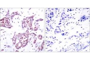 Immunohistochemistry analysis of paraffin-embedded human breast carcinoma, using STAT6 (Phospho-Tyr641) Antibody.