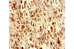 Immunohistochemistry of paraffin-embedded human melanoma using ABIN7168949 at dilution of 1:100 (Seryl-tRNA Synthetase (SARS) (AA 2-233) antibody)