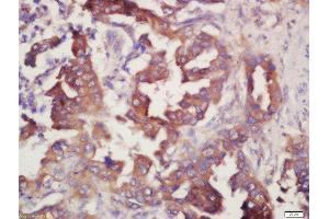 Formalin-fixed and paraffin embedded human lung carcinoma labeled with Rabbit Anti-Prostaglandin E Receptor EP4 Polyclonal Antibody, Unconjugated (ABIN1387963) at 1:200 followed by conjugation to the secondary antibody and DAB staining (PTGER4 antibody  (AA 151-250))