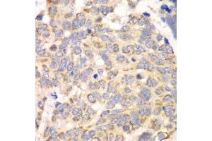 Immunohistochemistry of paraffin-embedded human esophageal cancer using HAGH antibody at dilution of 1:100 (x40 lens). (HAGH antibody)